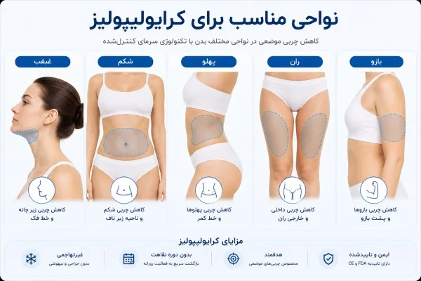 تصویر نواحی مناسب برای کرایولیپولیز