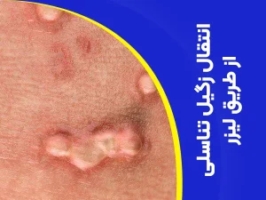 تصویر انتقال زگیل تناسلی از طریق لیزر