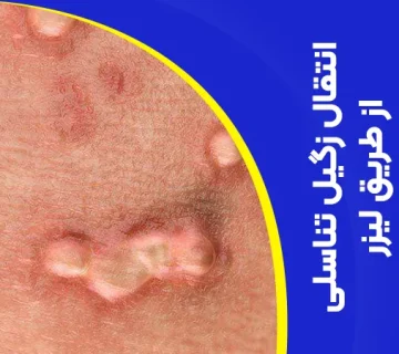 تصویر انتقال زگیل تناسلی از طریق لیزر