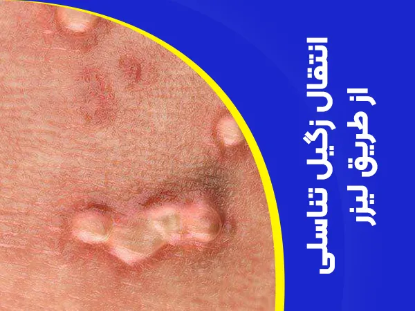 تصویر انتقال زگیل تناسلی از طریق لیزر