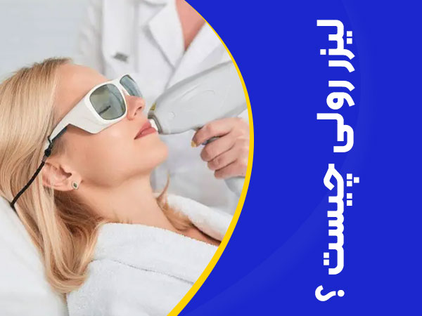 تصویر لیزر رولی چیست