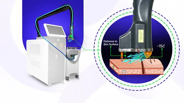 تصویر تاثیر لیزر بار الکس اپتیمکس