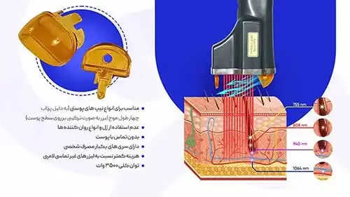 تصویر تاثیر هندپیس دستگاه لیزر الکساندرایت اپتیمکس بر روی حذف موهای زائد