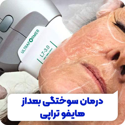 تصویر درمان سوختگی بعد از هایفوتراپی