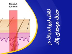 تصویر نقش لیزر اندیاگ در از بین بردن موهای زائد