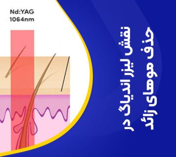 تصویر نقش لیزر اندیاگ در از بین بردن موهای زائد