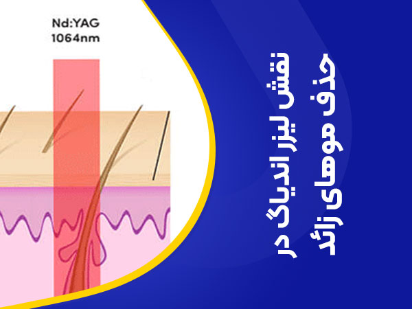 تصویر نقش لیزر اندیاگ در از بین بردن موهای زائد