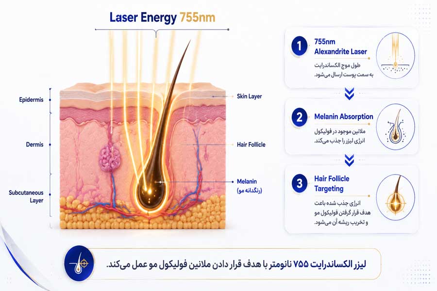 تصویر نقش طول موج الکساندرایت در حذف موهای زائد