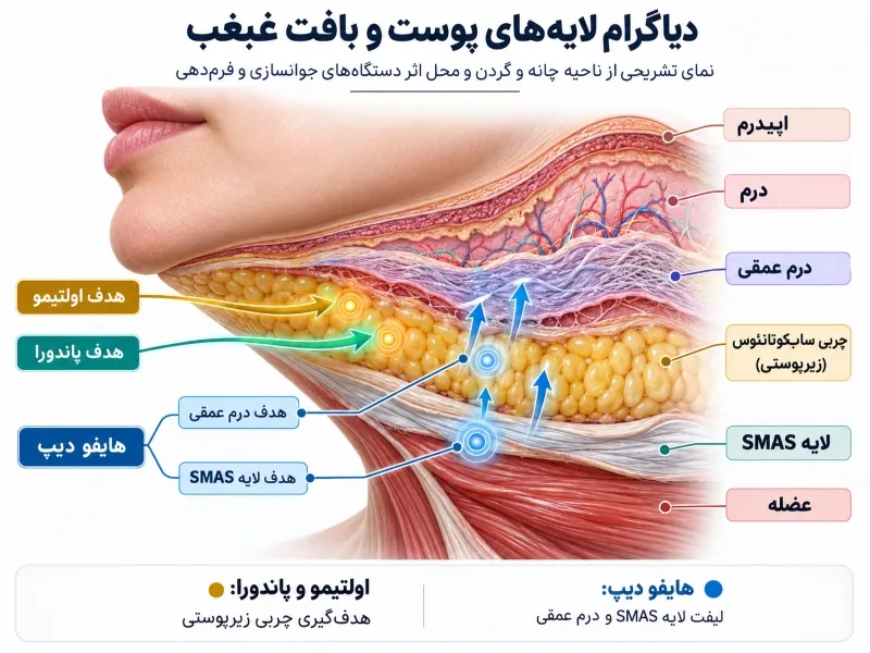 تصویر آناتومی لایههای بافت چربی و SMAS غبغب و عمق نفوذ دستگاه های لاغری کلینیکی